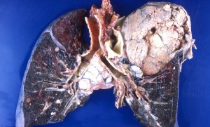 Unspecified Carcinoma of the Lung