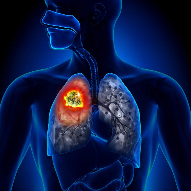 Radon and Lung Cancer in Non-Smokers