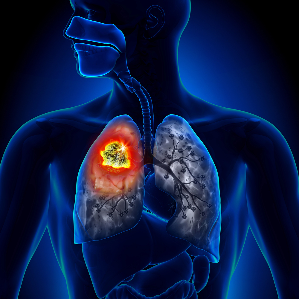 Radon and Lung Cancer in Non-Smokers